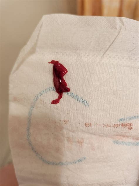 Hoe Ziet Een Vroege Miskraam Eruit - Zwangerschap en geboorte