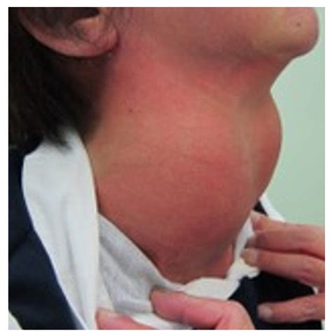 A Case of Giant Goiter Associated with Airway Stenosis Caused by Long ...