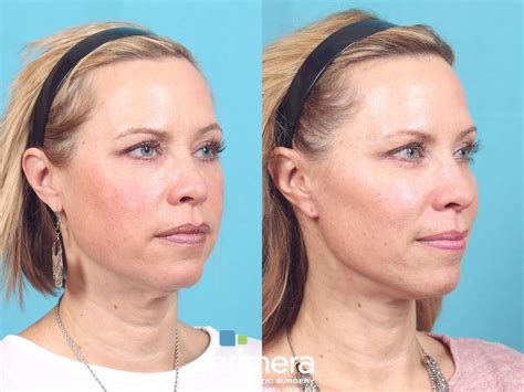 How To Get a Better Jawline: 7 Targeted Surgical & Nonsurgical Methods – Primera Plastic Surgery