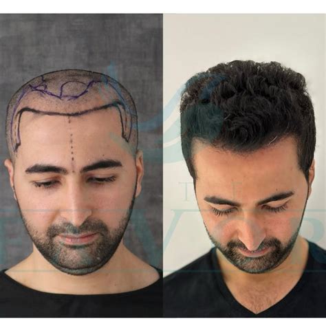Hair Transplant Turkey - Prices and Best Hair Clinics 2025 - En İyi Saç ...