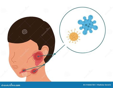 A Person with Viral Inflammation of the Salivary Glands Stock Vector ...