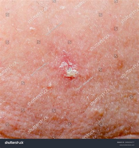 31 Scalp Basal Cell Carcinoma Royalty-Free Images, Stock Photos & Pictures | Shutterstock