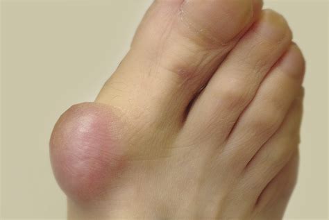 Foot Surgery - Foot Pain Centres of Leeds