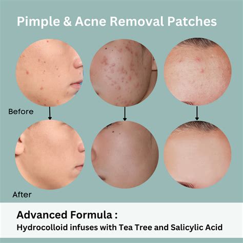 Pimple Patches - Natuderma Hydrocolloid Acne Patches , Invisible, Ultr ...