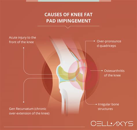 Can Pad Cause Knee Pain at Sarah Alanson blog