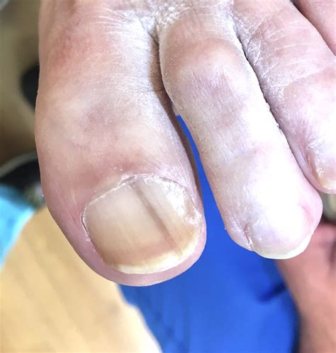 Dark Lines On Toenails Meaning