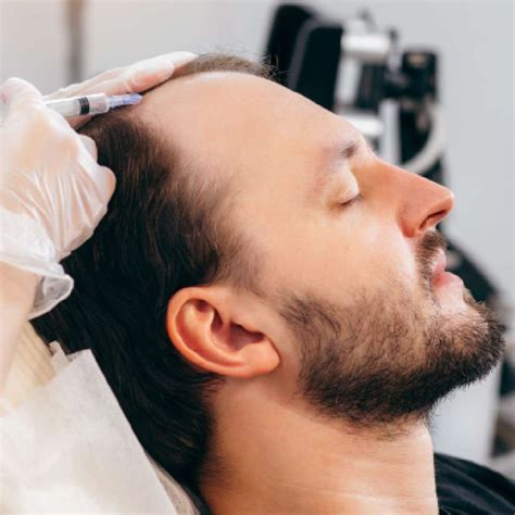 Exosomes For Hair Loss