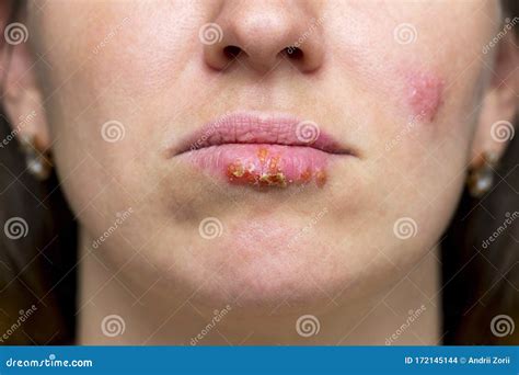 Part Of A Young Woman Face With Red Bubbles Of Virus Herpes On Lips ...