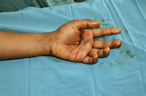 Wounds And Lacerations at Erin Birks blog