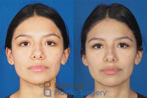 JUVÉDERM® Dermal Fillers Washington, DC, & Arlington, VA | Potomac Plastic Surgery®