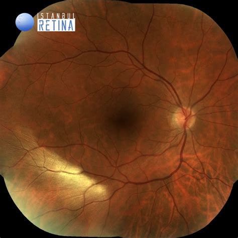 56. Myelinated Retinal Nerve Fiber Layer | OCT Club - layers of retina oct
