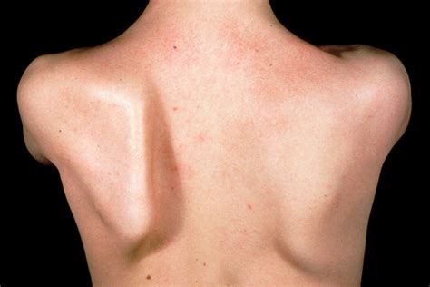 Orthopaedic clinic - winged scapula - Pulse Today