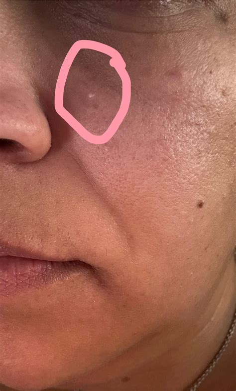 That “white pimple” that won’t go away… : r/30PlusSkinCare