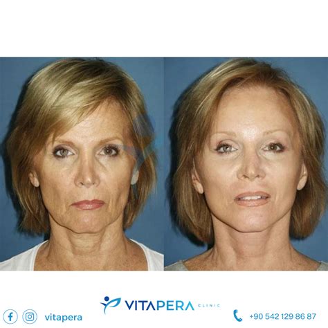 Endoscopic Mid Face Lift in Turkey | Vitapera