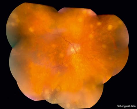 Sympathetic Ophthalmia - Clinical Tree