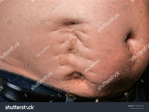 Appendix Surgery Scar: Over 320 Royalty-Free Licensable Stock Photos | Shutterstock