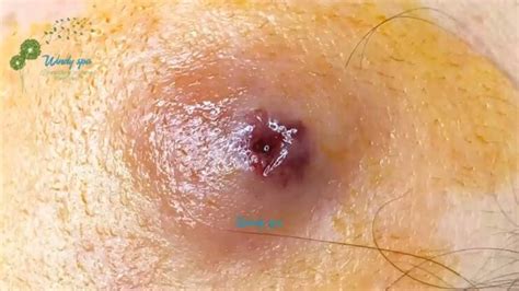 Safe and Effective Removal of Stubborn Sebaceous and Epidermoid Cysts ...