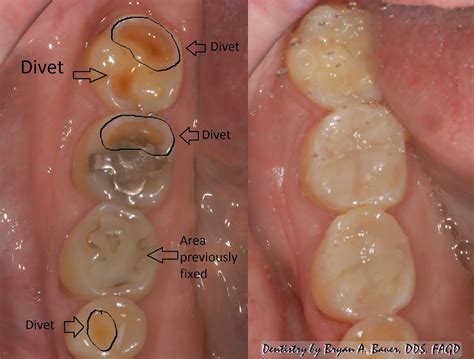 Tooth Erosion At Gum Line at Katie Felton blog