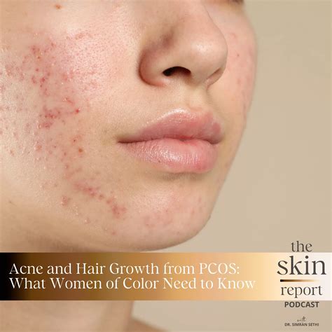 Acne and Hair Growth from PCOS: What Women of Color Need to Know
