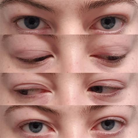 Is there such a thing as "EDS eyes"? : ehlersdanlos