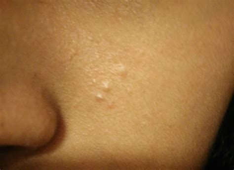 Small Pimples On Face