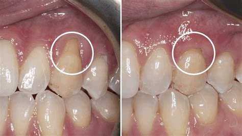 Can Cosmetic Dentistry Fix Receding Gums at Dean Ransford blog