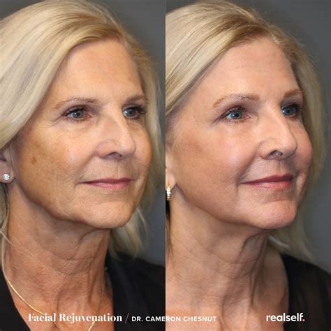 Skin Tightening | Laser skin treatment, Laser face treatment, Laser facial