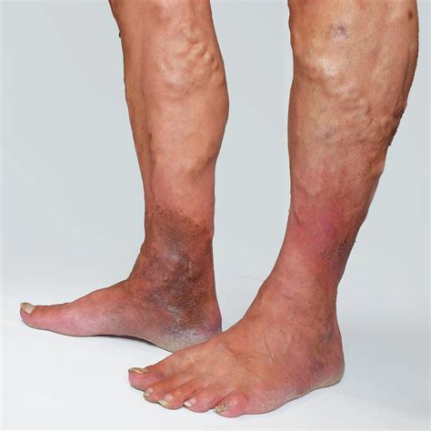 What Is Hemosiderin Staining? Ankle Bruising Vein Institute, 59% OFF