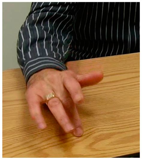 Muscle Selection for Focal Limb Dystonia