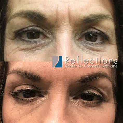 Botox for Under Eye Wrinkles & Frown Lines Before & After Photos New Jersey - Reflections Center