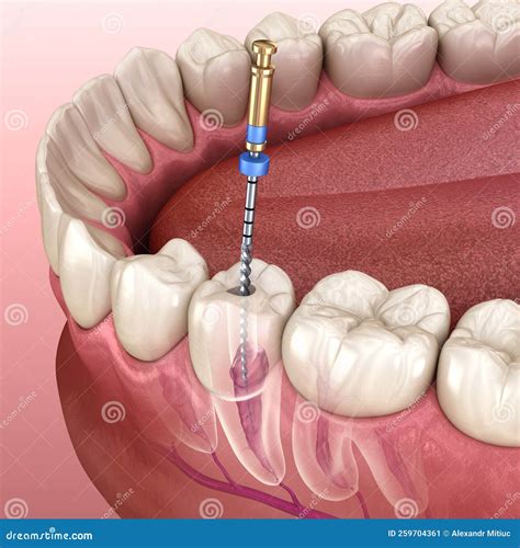 Different Stages Of Endodontic Treatment at Jackie Roberts blog