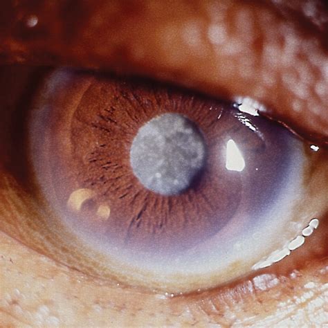 Cloudy Skies Ahead? Understanding and Overcoming Cataracts - Fillmore ...