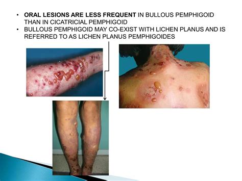 Pemphigus and Pemphigoid | PPTX