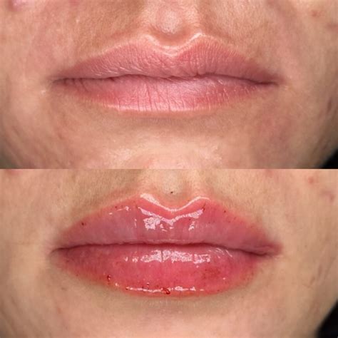 Lip Filler in Lakewood Ranch FL - Natural Results | Serving Bradenton ...