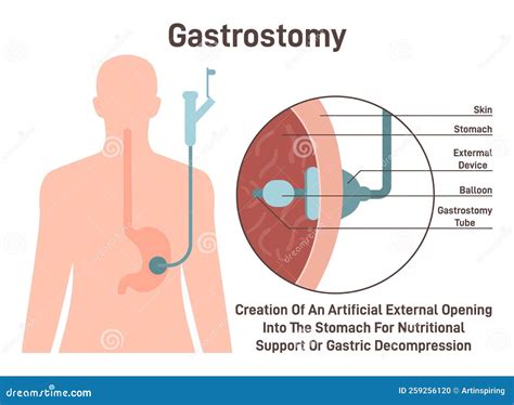 Gastrostomy. Gastric Inserted Feeding Tube, Food Nutritions Injecting ...