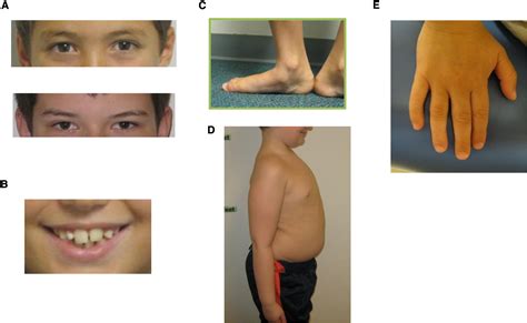 47,XYY Syndrome: Clinical Phenotype and Timing of Ascertainment - The Journal of Pediatrics