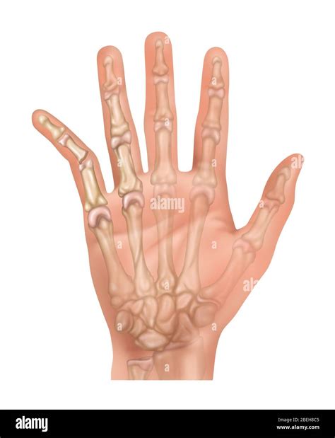 Dislocated Pinky Finger