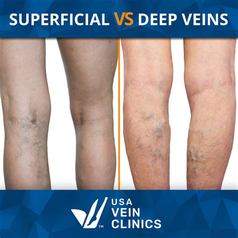 Superficial Venous Thrombosis