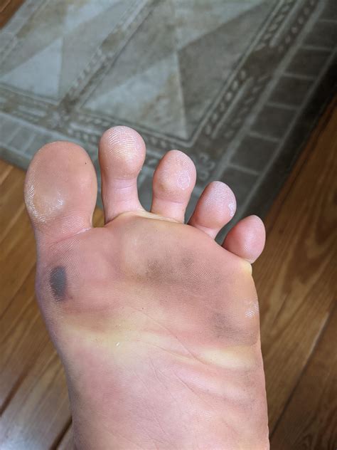 Blood Blister Pad Of Foot at Robert Bence blog