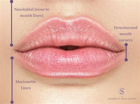 The Best Way to Fix Downturned Mouth Corners | Filler, Botox for ...