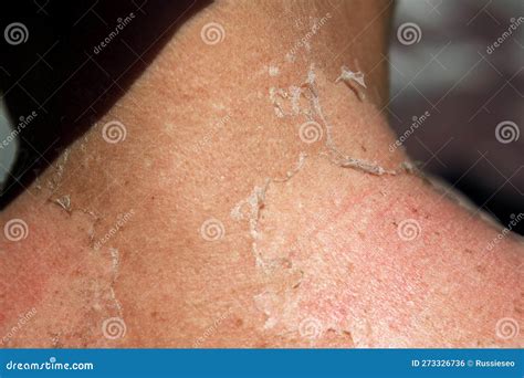 Peeling skin on the neck stock photo. Image of hurt - 273326736