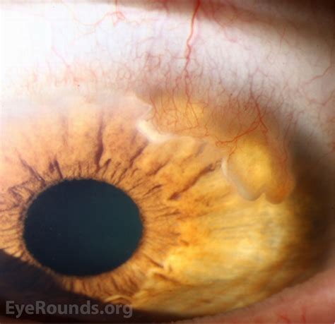 Terriens Marginal Degeneration