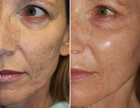#1 Microneedling Scottsdale Med Spa - Restore Youthful Skin!