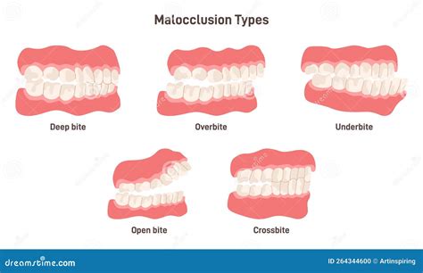 Types Of Malocclusion Of Teeth – KLPCP