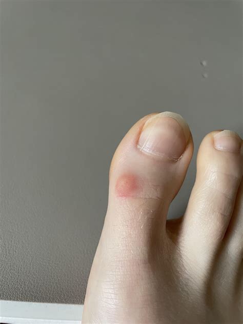 Painful lump on toe joint that has grown quickly? : r/FootFunction