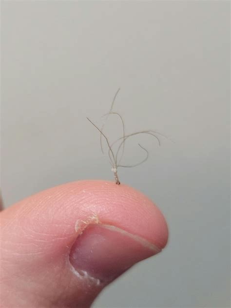 Pili Multigemini - multiple hairs growing from the same follicle : r ...