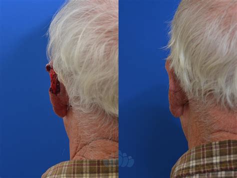 Facial Nerve Damage After Mohs Surgery at Marlene Boyd blog