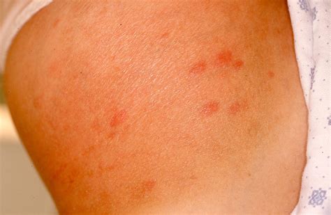 Pathology Outlines - Dermal hypersensitivity reaction