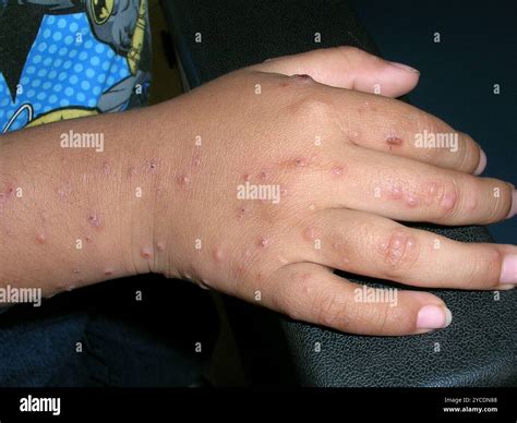 Gianotti-Crosti syndrome (infantile papular acrodermatitis) on the hand ...