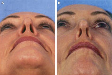 Surgical Treatment of Nasal Obstruction in Rhinoplasty - Clinics in Plastic Surgery